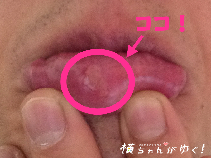 口内炎3