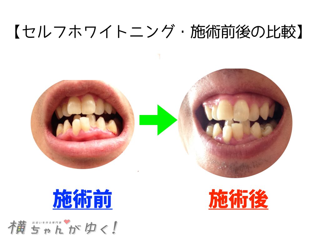 ホワイトニング比較
