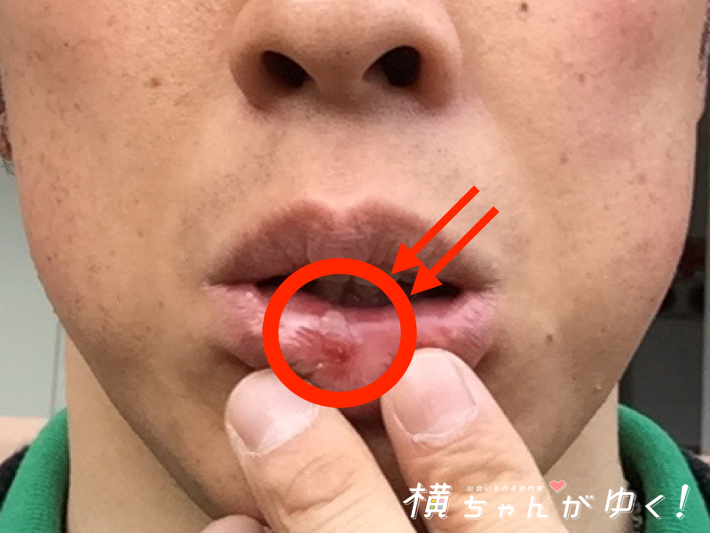 口内炎5
