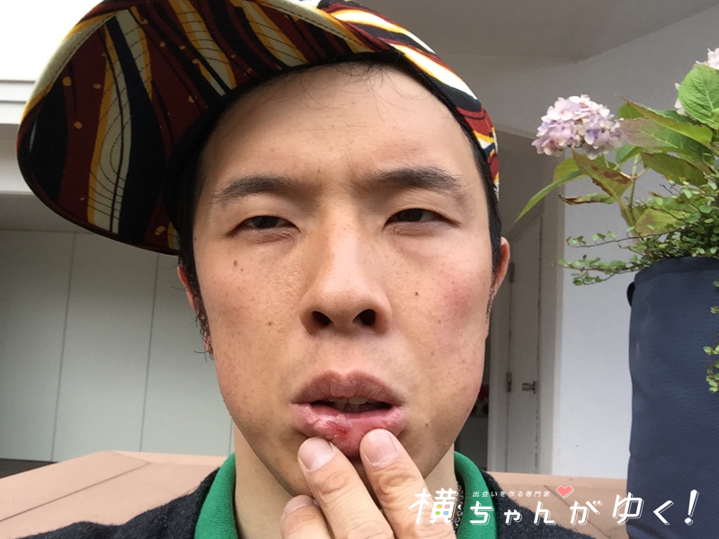 口内炎4